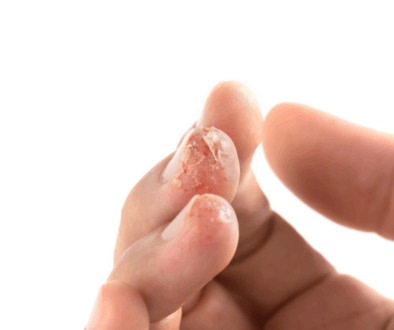 Eczema on fingers