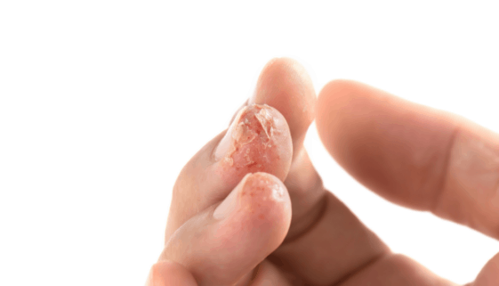 Eczema on fingers